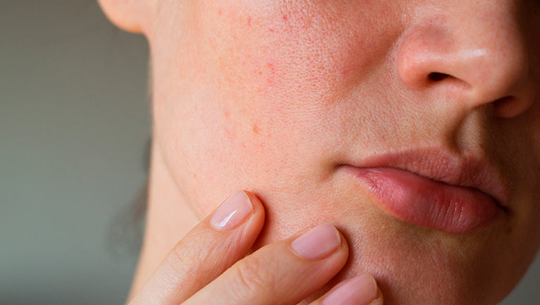 Skincare pelle mista: la beauty routine perfetta per brillare